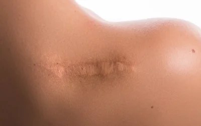 Narbenmassage & Pigmentierung – dein sanfter Kombi-Plan